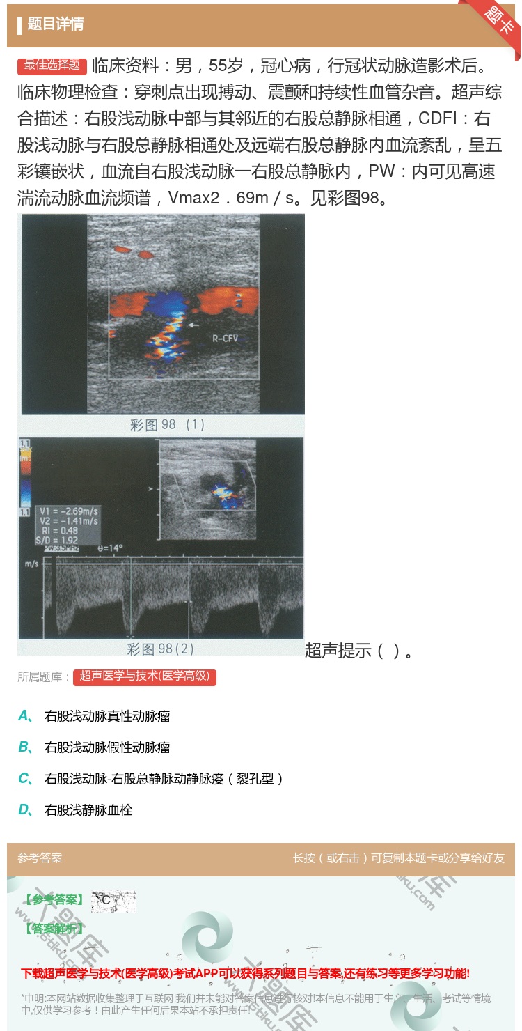 答案:临床资料男55岁冠心病行冠状动脉造影术后临床物理检查穿刺点出...